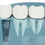 Implantologia a carico immediato: cos’è, indicazioni, costi