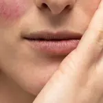 Rosacea viso: cause, sintomi e cure